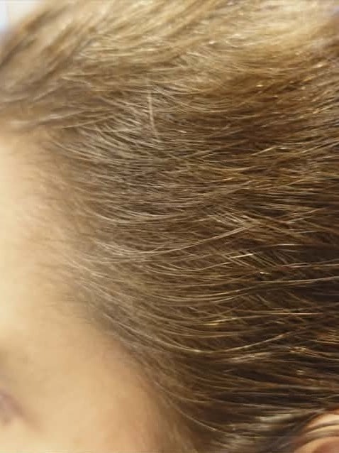 After treatment