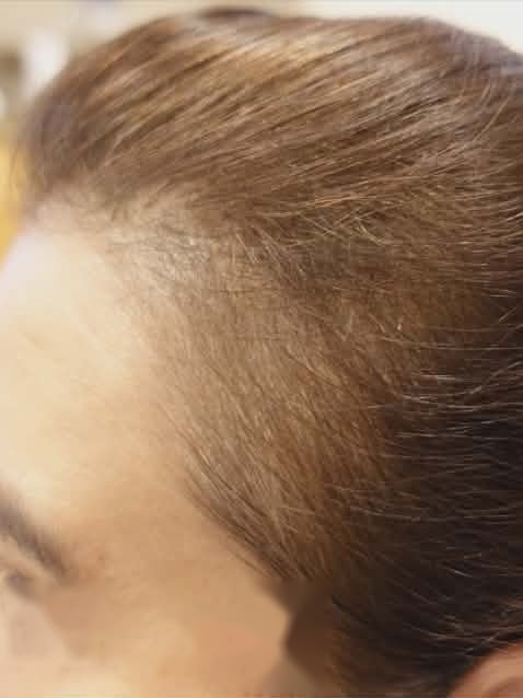 Before treatment