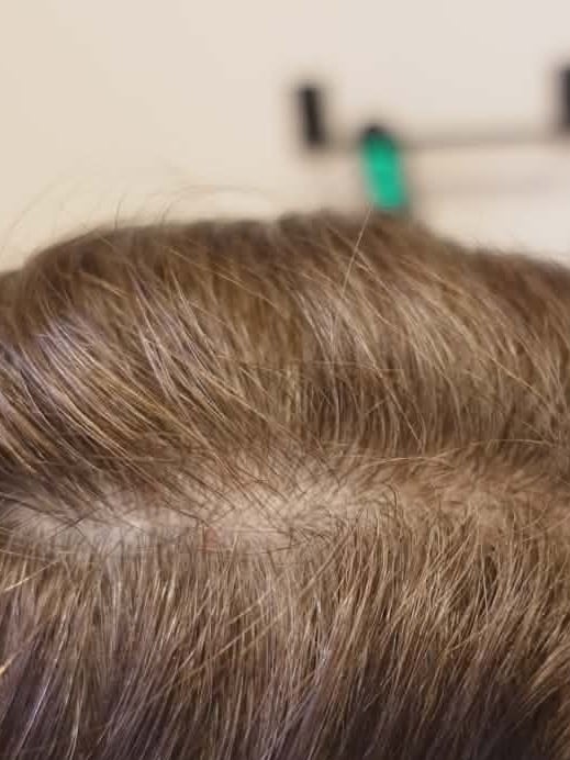 After treatment